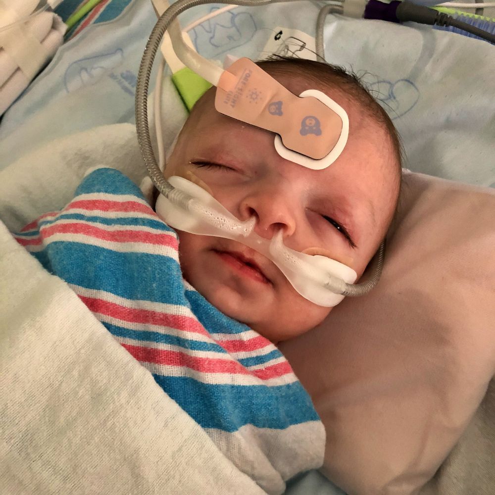 Baby with medical equipment on face and head, wrapped in striped blanket